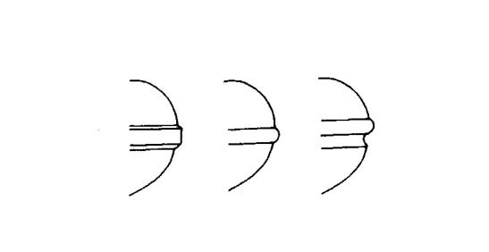  Trái: Phúc tuyến vuông Giữa: Phúc tuyến tròn Bên phải: Phúc tuyến lồi lõm